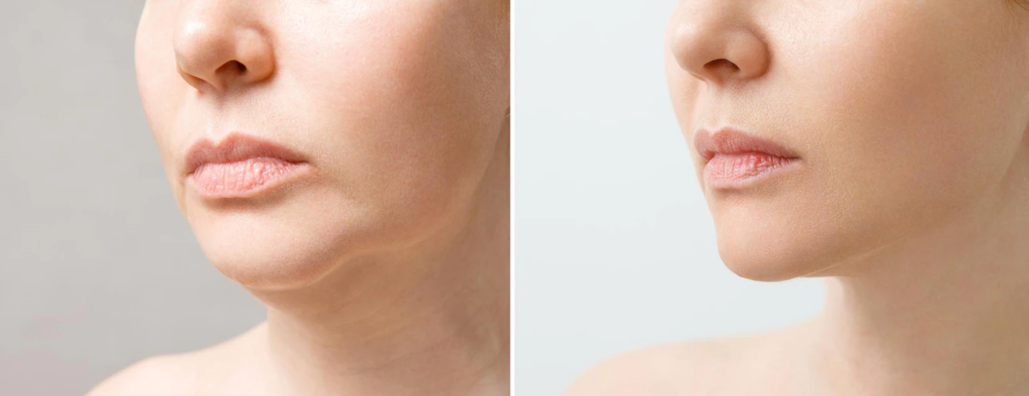 KYBELLA® Before and After