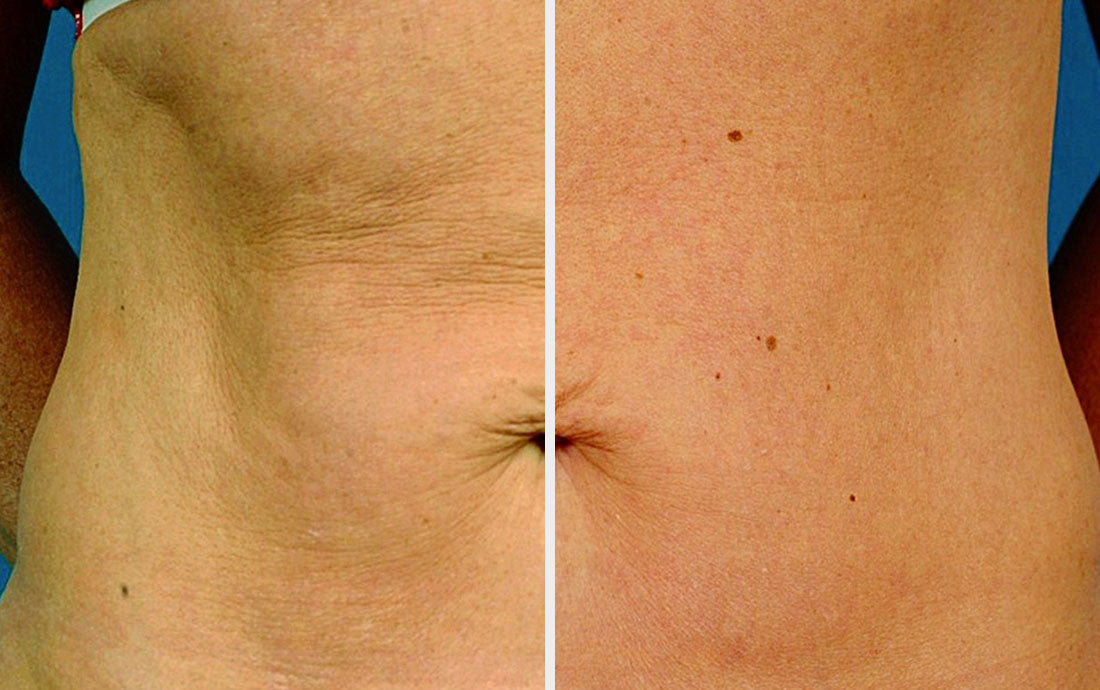 Before and After VIORA REACTION™ RF