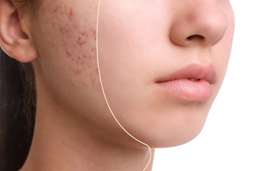 Acne Facial Services in Vail Colorado