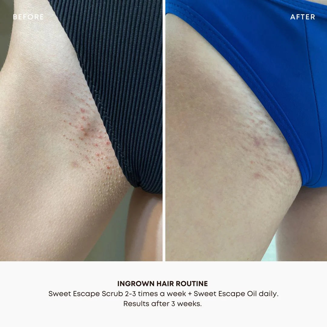 Bushbalm | Sweet Escape Ingrown Hair & Pre-Post Wax Oil Results