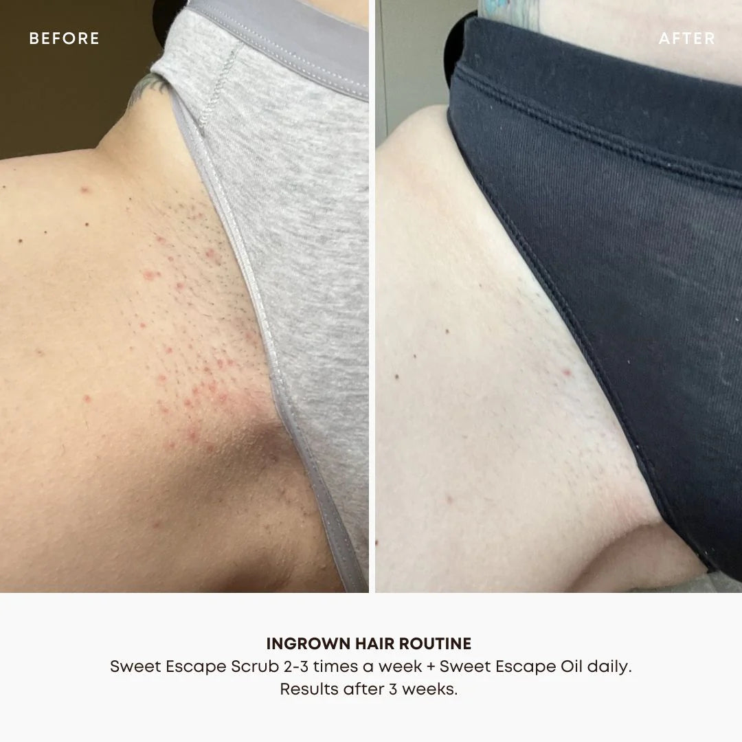 Bushbalm | Sweet Escape Ingrown Hair & Pre-Post Wax Oil Before And After