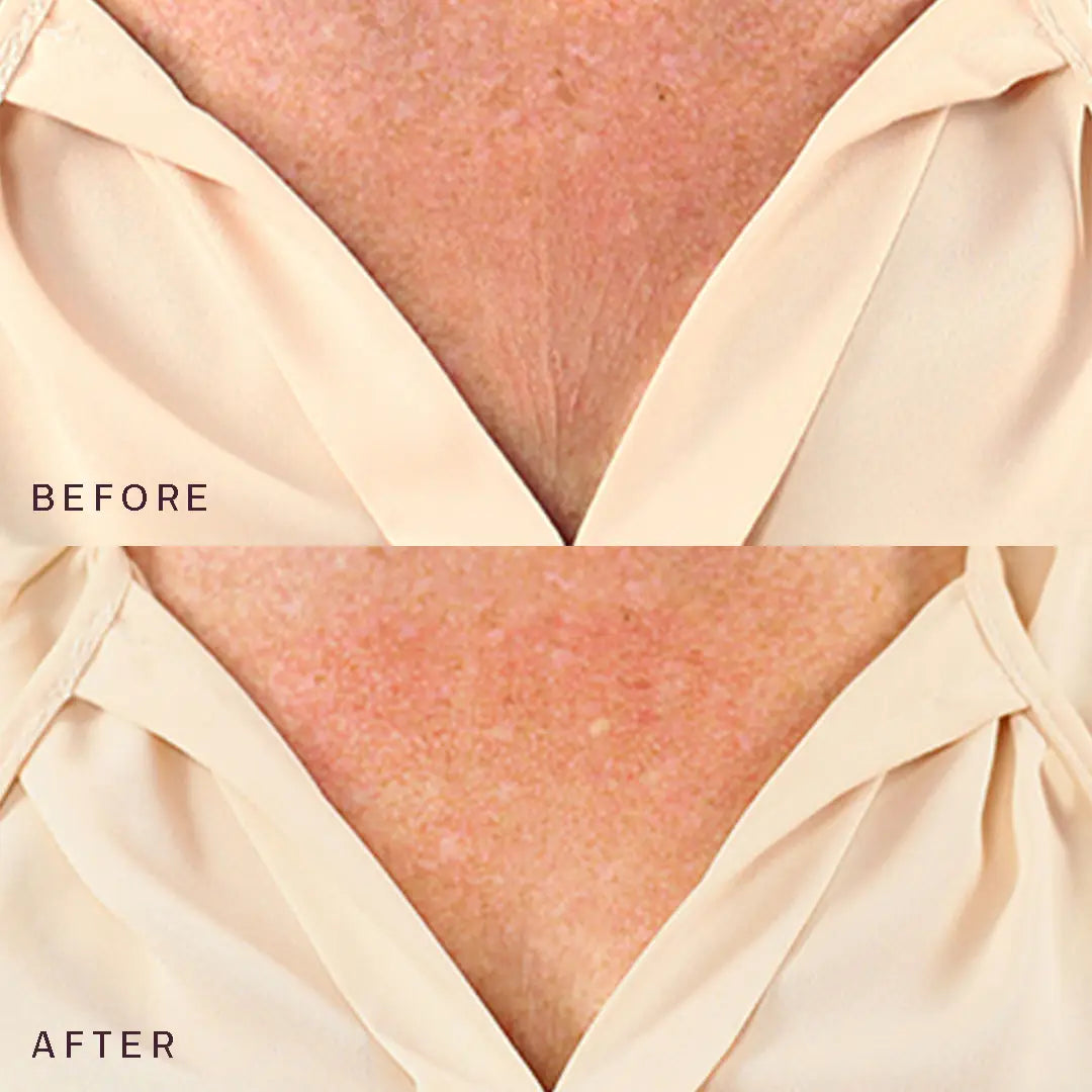 Dermaclara | 5” Décolleté, Breast, & Butt Occlusion Patch 5