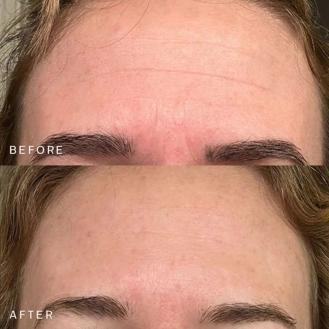 Dermaclara | Forehead Occlusion Patch Results
