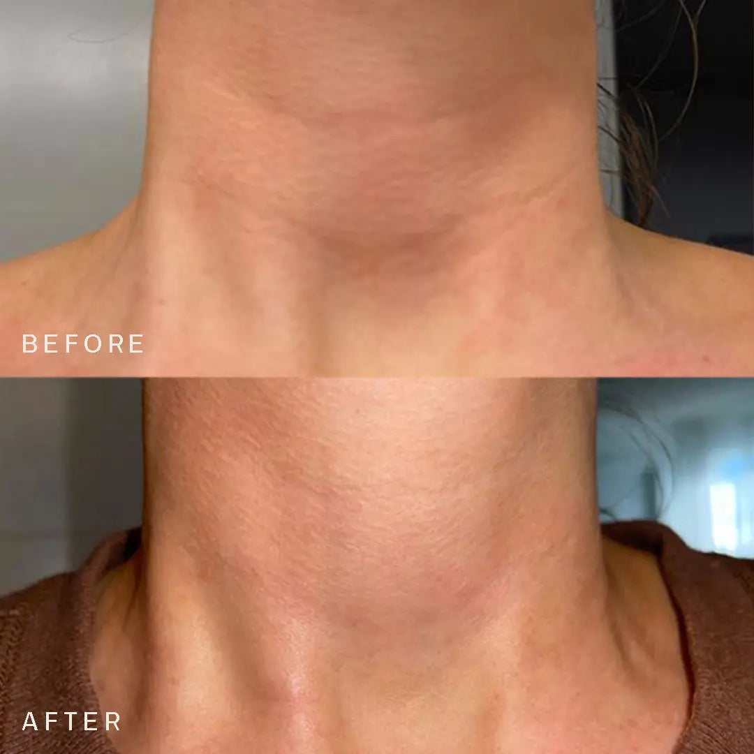 Dermaclara | Neck Occlusion Patch Before And After