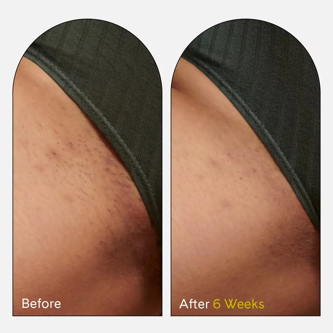 Fur | Ingrown Eliminator Serum Rollerball Before And After
