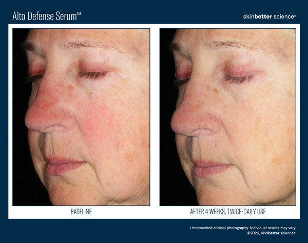 Skin Better Science | Alto Defense Serum (50ml) Result