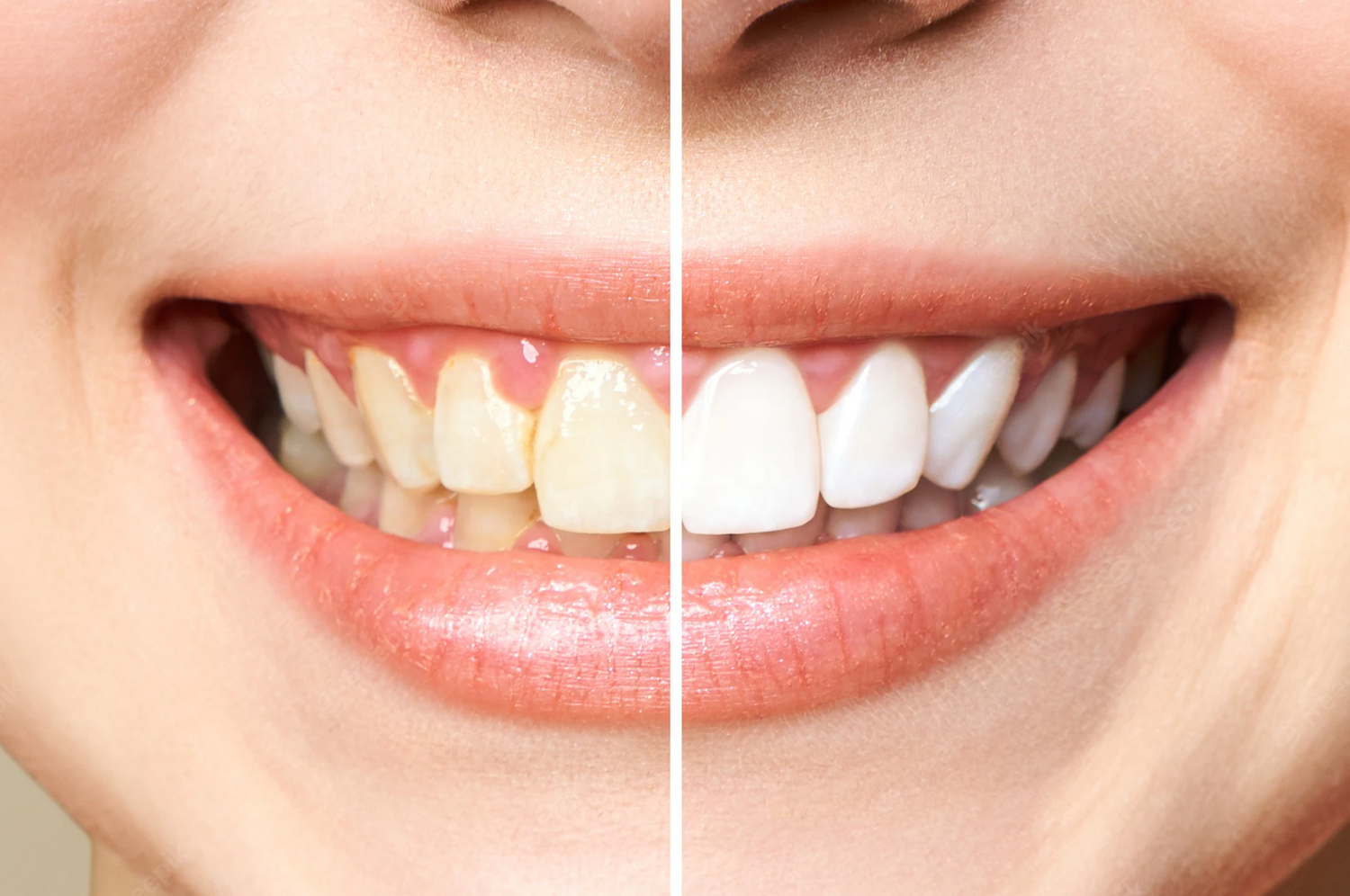 Before and After Using Da Vinci Teeth Whitening
