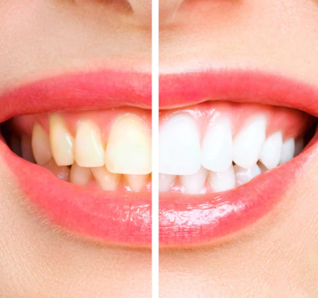 Before and After Using Da Vinci Teeth Whitening