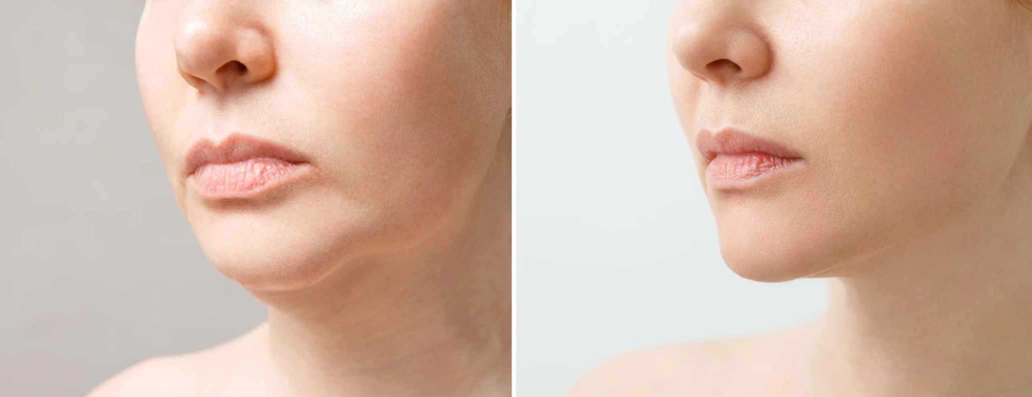 KYBELLA®  Before and After