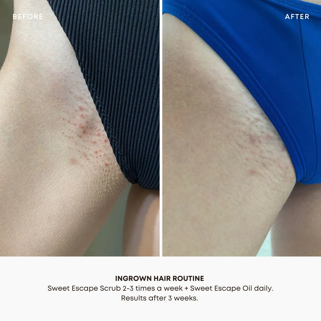 Bushbalm | Sweet Escape Ingrown Hair &amp; Pre-Post Wax Oil Results