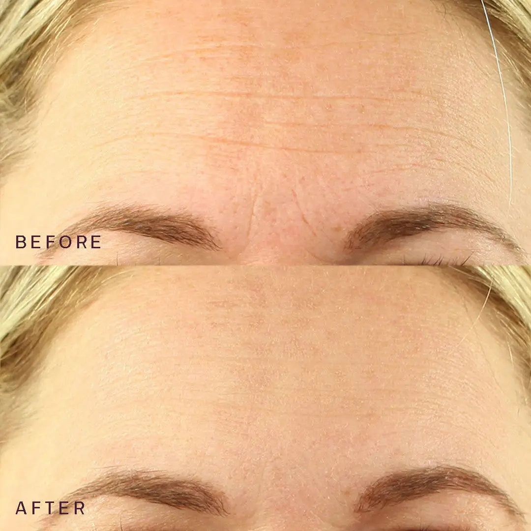 Dermaclara | Face To Face Bundle Before And After Forehead